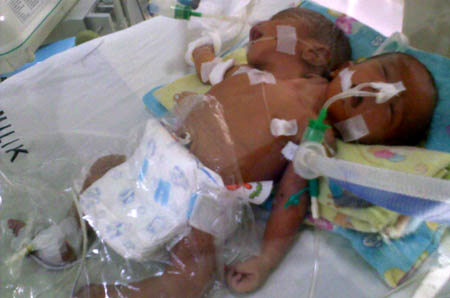 A Baby with Two Heads